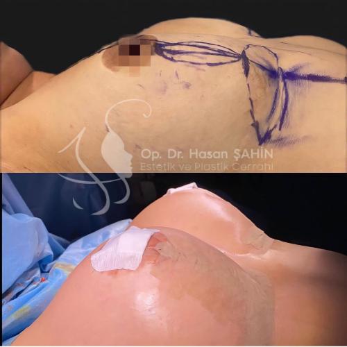 Breast lift Before / After photo